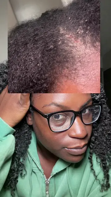 MY SCALP IS SO MUCH BETTER NOW!! #psoriasis #psoriasisawareness #dryscalp #itchy