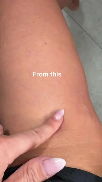 Vitamin C helps improve the appearance of stretch marks ✨ @Arencia 🤍 #skin #ski