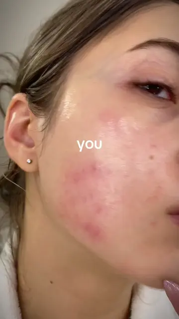 5 moisturizers and 1 year later I finally cleared my skin #clearskin #acneprone 