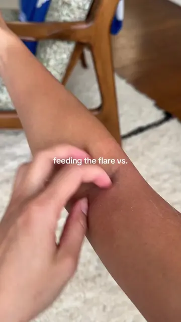 Which side are you on? Tag someone who needs to see this 💙 #eczema #eczemacare 