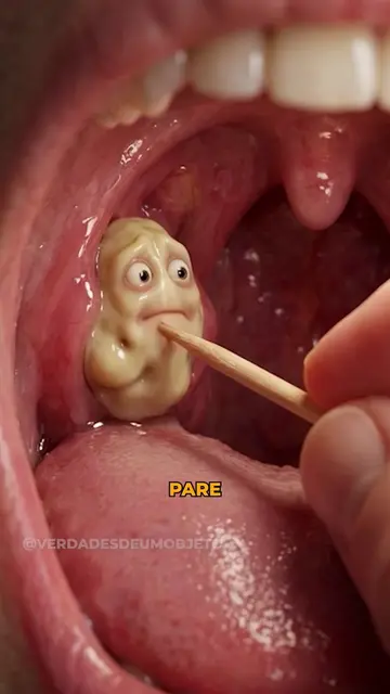😮 Você tenta tirar cáseo com o dedo ou com palito?Além de machucar a garganta, 