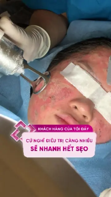 Có phải điều trị sẹo càng nhiều, sẹo sẽ nhanh hết? #doctorlaser #bsluong #sẹorỗ 