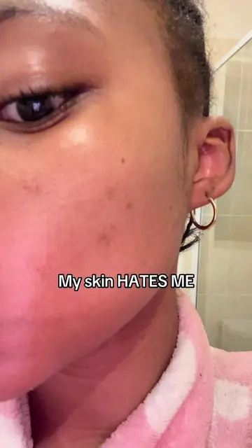 Unbelievable🥹 Comment SKIN for tips💖 #skincare #clearskin #largepores #acne #p