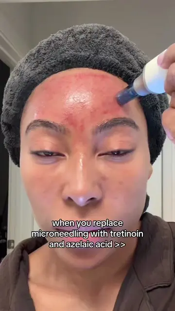 will resume microneedling in the fall.. I still love it.. just too hot for that 