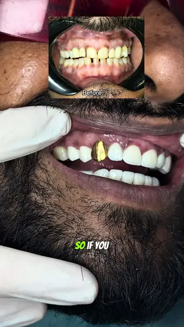 Dental Gold Crown in Pakistan🦷🇵🇰 | #drharoonshah #foryou #smilemakeover #Lear