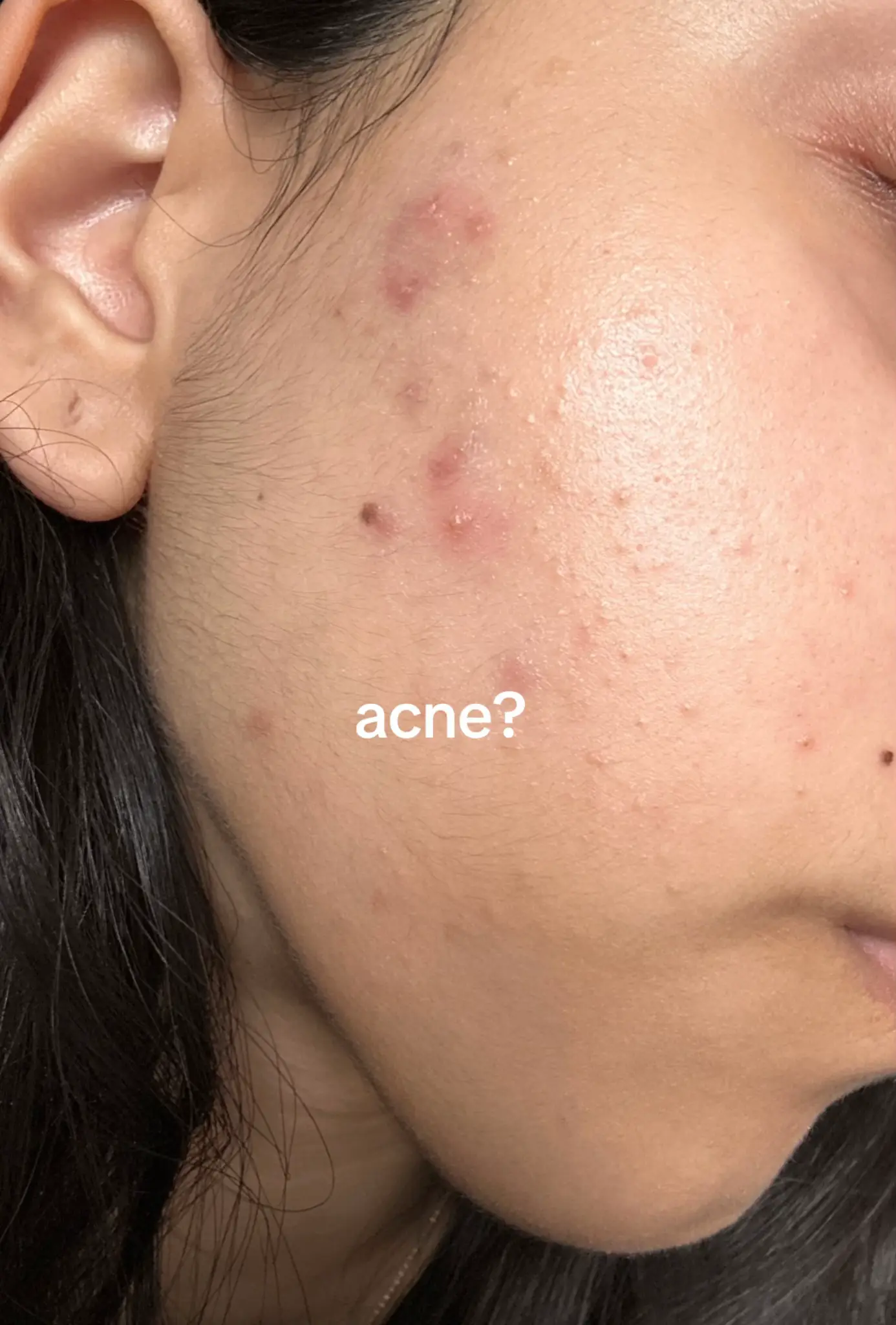 Struggled with acne for almost 2 years before I finally perfected my skincare ro