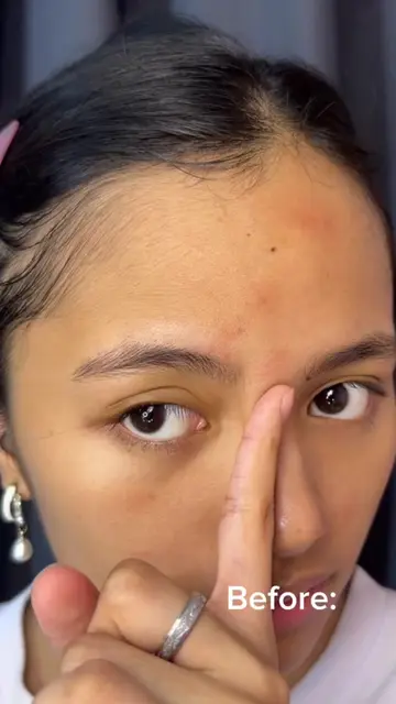 ✨ Say goodbye to stubborn pimples! 💚 The PURITO Azelaic Acid Serum helps calm b