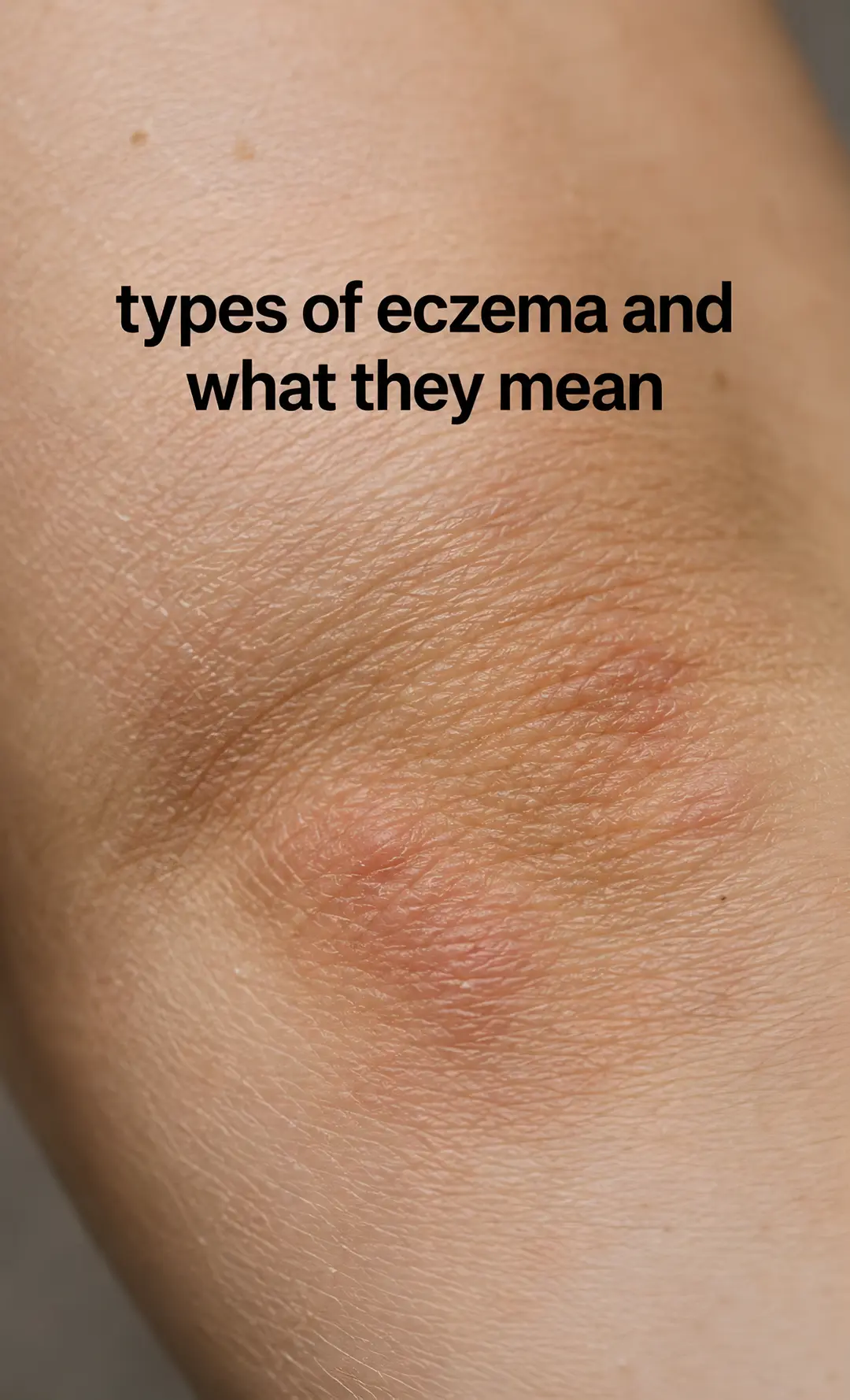 types of eczema and what they mean, part of understanding what you're actually d