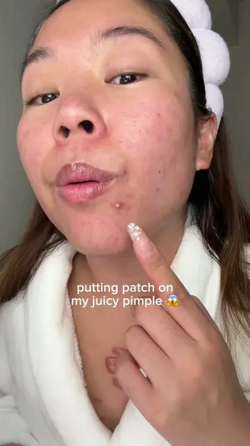 anyone else breakout on their chin every time their period comes 🫠 #acne #pimpl
