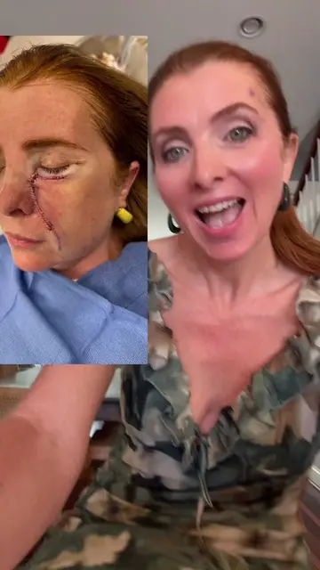 Replying to @peach I had Moh’s surgery to remove Basal Cell Carcinoma which left