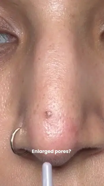 Clogged pores? enlarged pores? sebaceous filaments? watch till the end...  @Beau