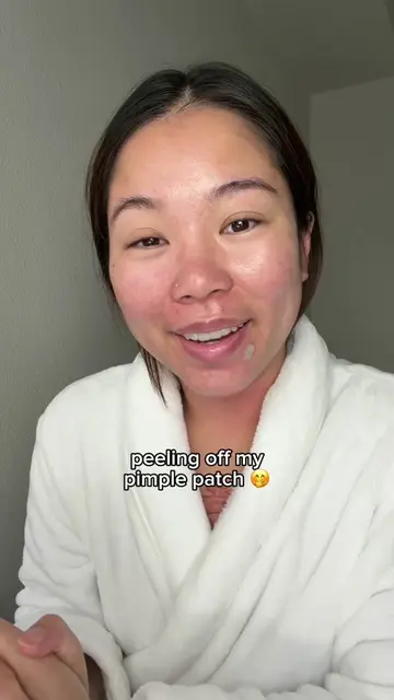 that was a 10/10 peel 🤩 #pimplepatch #acne #skincare  @Easyderm 