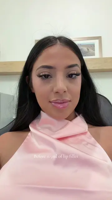 Does it look the same? 🧐 #lipfiller #foryoupage #fypシ゚viral 