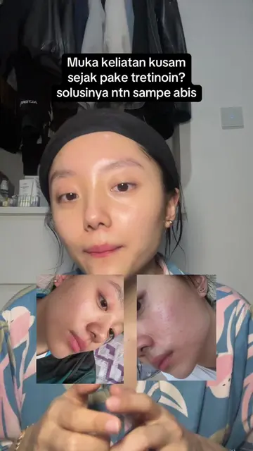 Banyak yang ngalamin muka kusam sejak pake tretinoin, solusinya sini aku kasih t