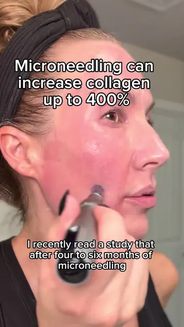 Microneedling is one of my favorite ways to build collagen at home. One of the r
