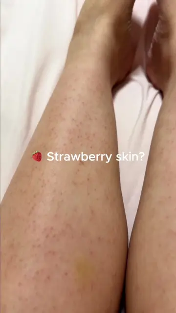 how to fix strawberry skin? 🍓 #strawberryskin #bodycare #keratosispilaris #celi
