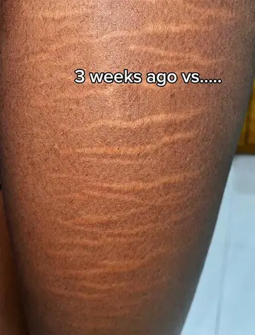 I've always believed stretch marks are completely normal, so they've never been 