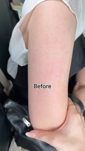 Day 21 | How to fix chicken skin @Amlactin 12% daily relief cream (no ad) #bodyc