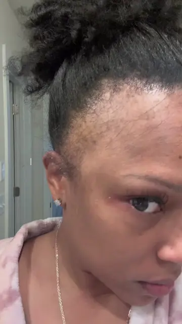 World stop, this is my 10 Months, Carry on 🥰💕 @Doctours #hairtransplant #hairt