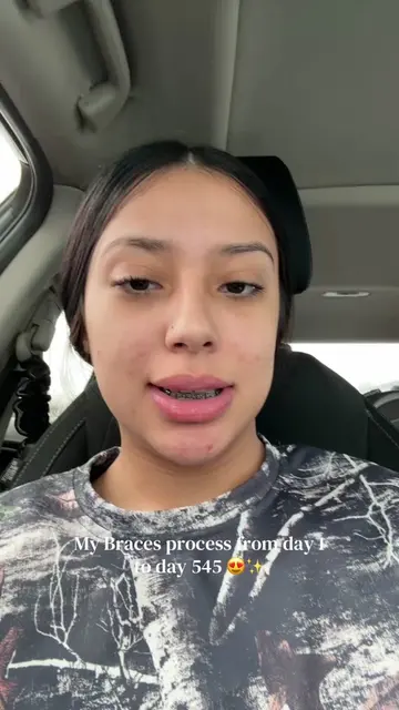 New smileee 🥹🥹 #fypシ゚viral #braces #bracesoff #foryoupage #viralvideo 