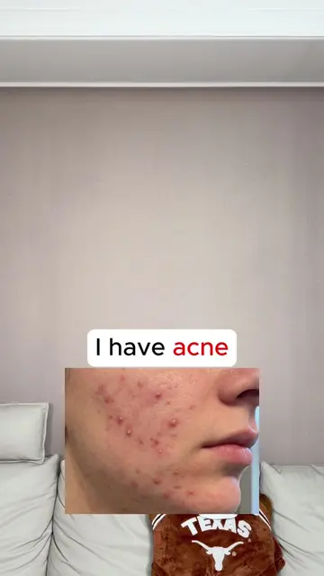 5 skin concerns. 1 answer.  Retinol covers: ✨ acne ✨ pores ✨ texture ✨ wrinkles 