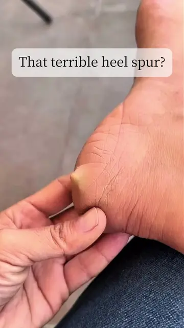 That sharp pain under your heel isn’t something to ignore. 🦶 A heel spur can ma