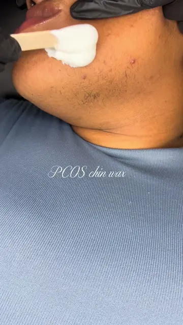If you have PCOS that causes unwanted facial hair, book that wax!  Waxing kills 