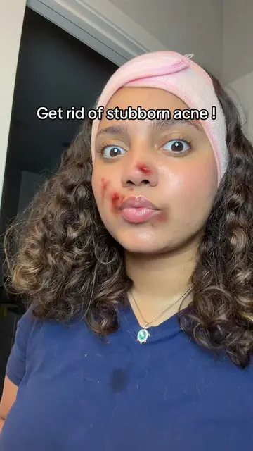 Stubborn acne no more ❌ #acne #clearskin #pimplesremover #fyp #viral 
