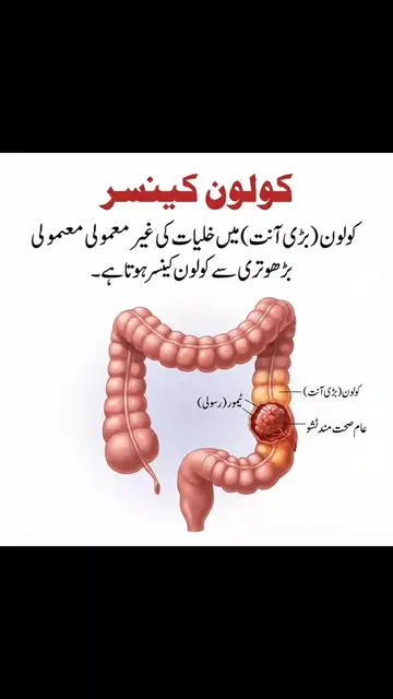 کولون کینسر (بڑی آنت کا کینسر) ایک ایسی بیماری ہے جو بڑی آنت (کولون) یا مقعد (ری