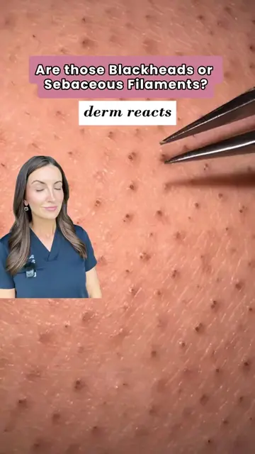 #sebaceousfilaments #sebaceousfilament #pores #largepores #largeporestreatment 
