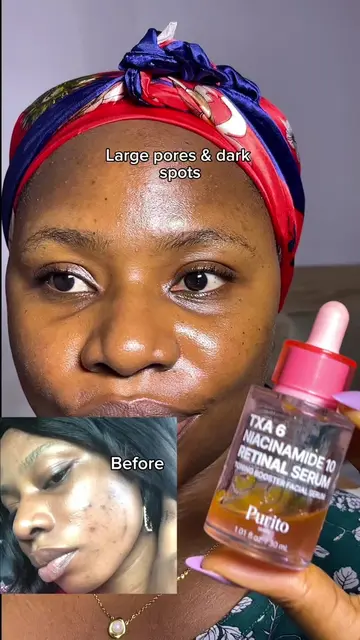 11 days. That’s all it took for the Purito TXA 6 Niacinamide 16 Retinal Serum to