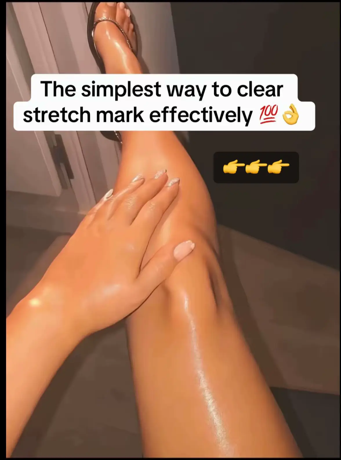 Stretch marks are completely normal, and while no product can erase them overnig