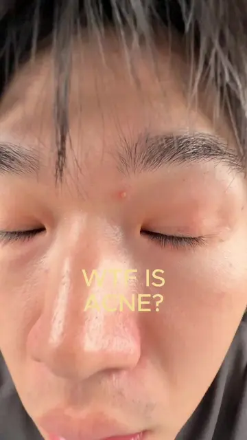 WTF IS ACNE? #skincare #skincareroutine #acne #acnetreatment #acnescars 