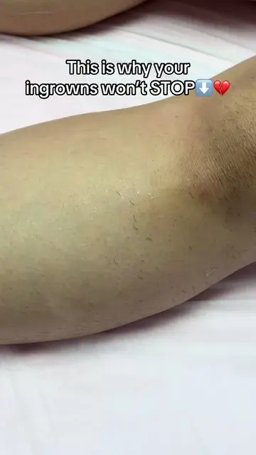 Not all ingrown hairs are created the same. Regular exfoliation helps remove tha