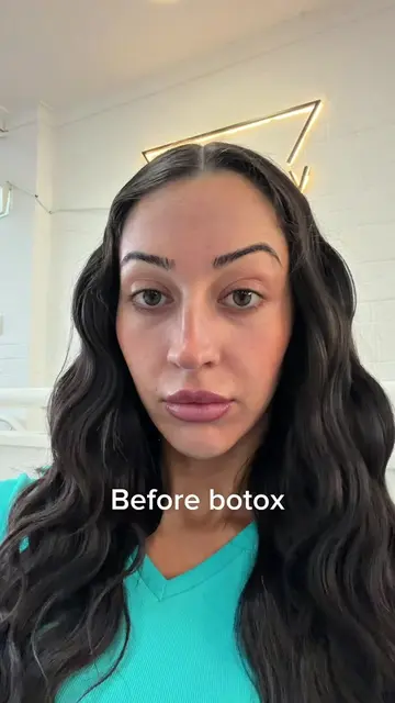 My fave treatment ever @the_melb_cosmetic #botox #antiwrinkle #SelfCare 