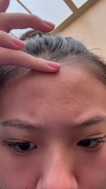 POV: You finally beat acne ✨ #acnesolution #SkinCare101 #beforeandafter #GlowUp 