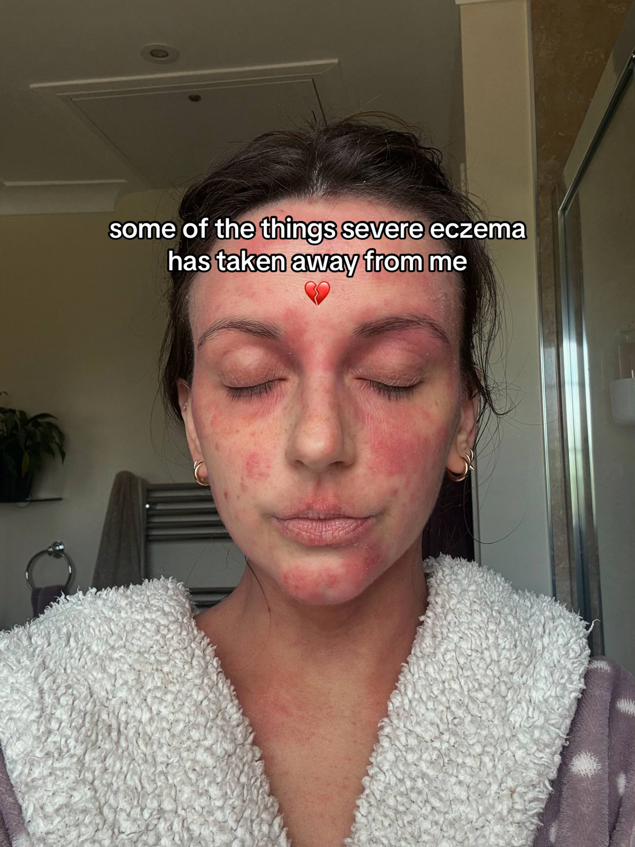 some of the things severe eczema has taken away from me 💔 #eczema #eczemaflareu