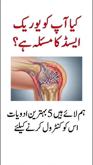 یوریک ایسڈ (Uric Acid) جسم میں بننے والا ایک قدرتی فضلہ (waste product) ہے جو اس