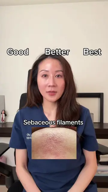 #sebaceousfilament #cloggedpores #acneproneskin #dermatologist #oilyskin 