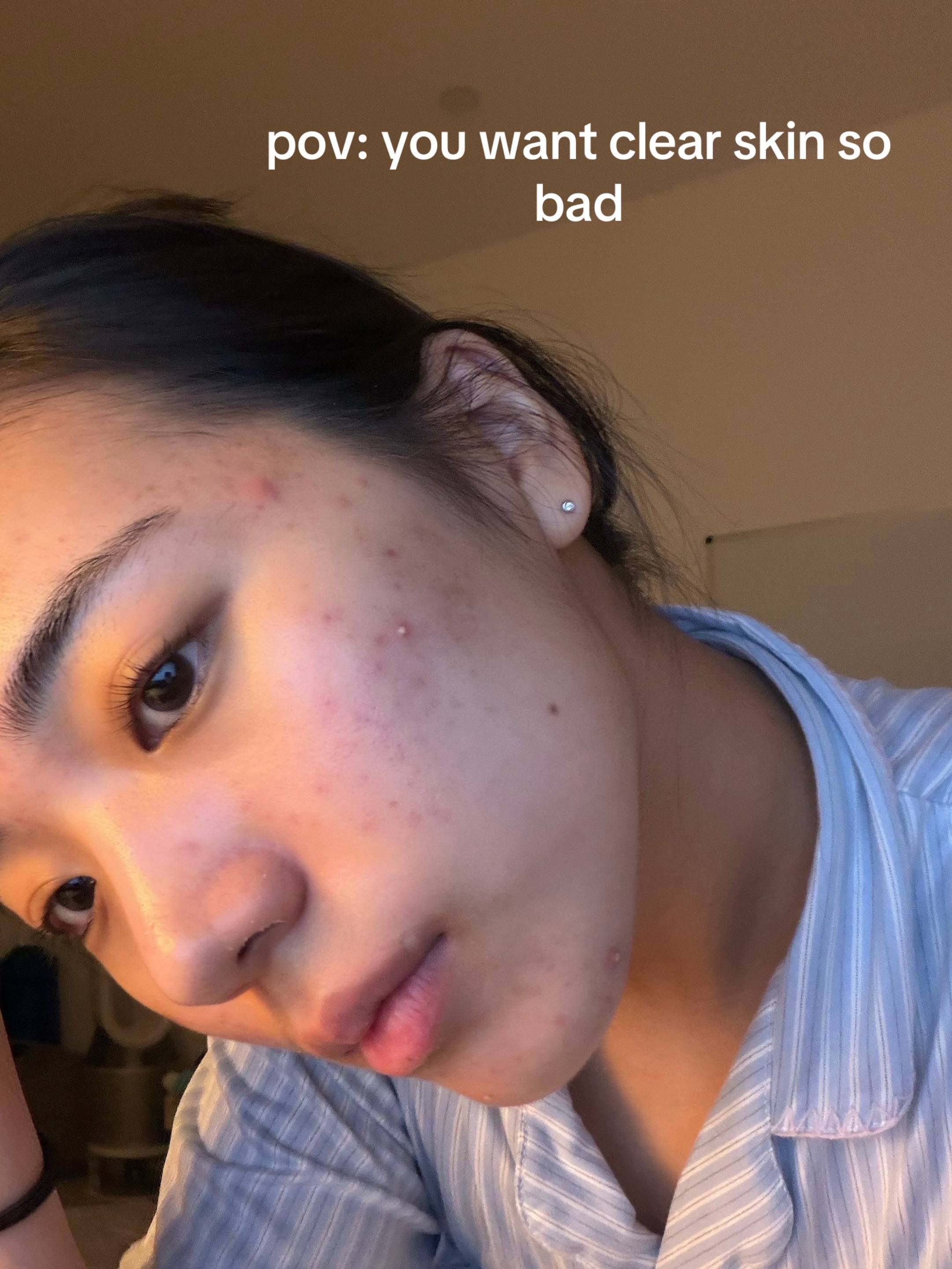 trust me you will clear ur skin in months😚 #skin #skincare #acne #acnetreatment