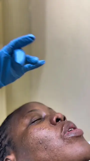 Today, @Faridah Nakazibwe came in for her microneedling session, and she's happy