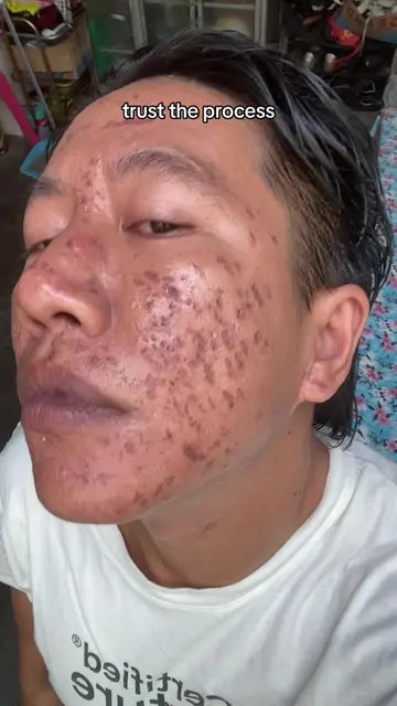 trust the process ! #GlowUp #skincare #skincareroutine #SelfCare #SelfImprovemen