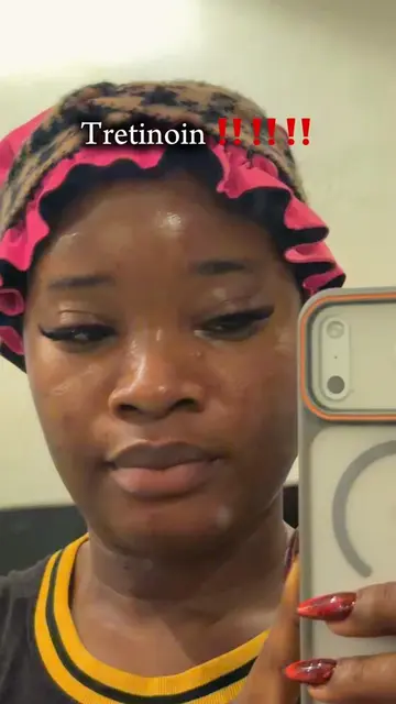 This is your sign to start your tretinoin journey NOW so by December you can sti