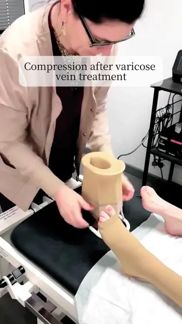 After varicose vein treatment, the way compression stockings are applied can mak