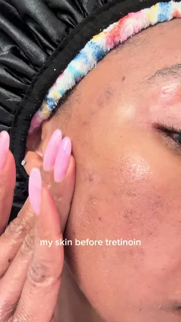 the way tretinoin and the sandwich method got my skin to where I wanted it to be