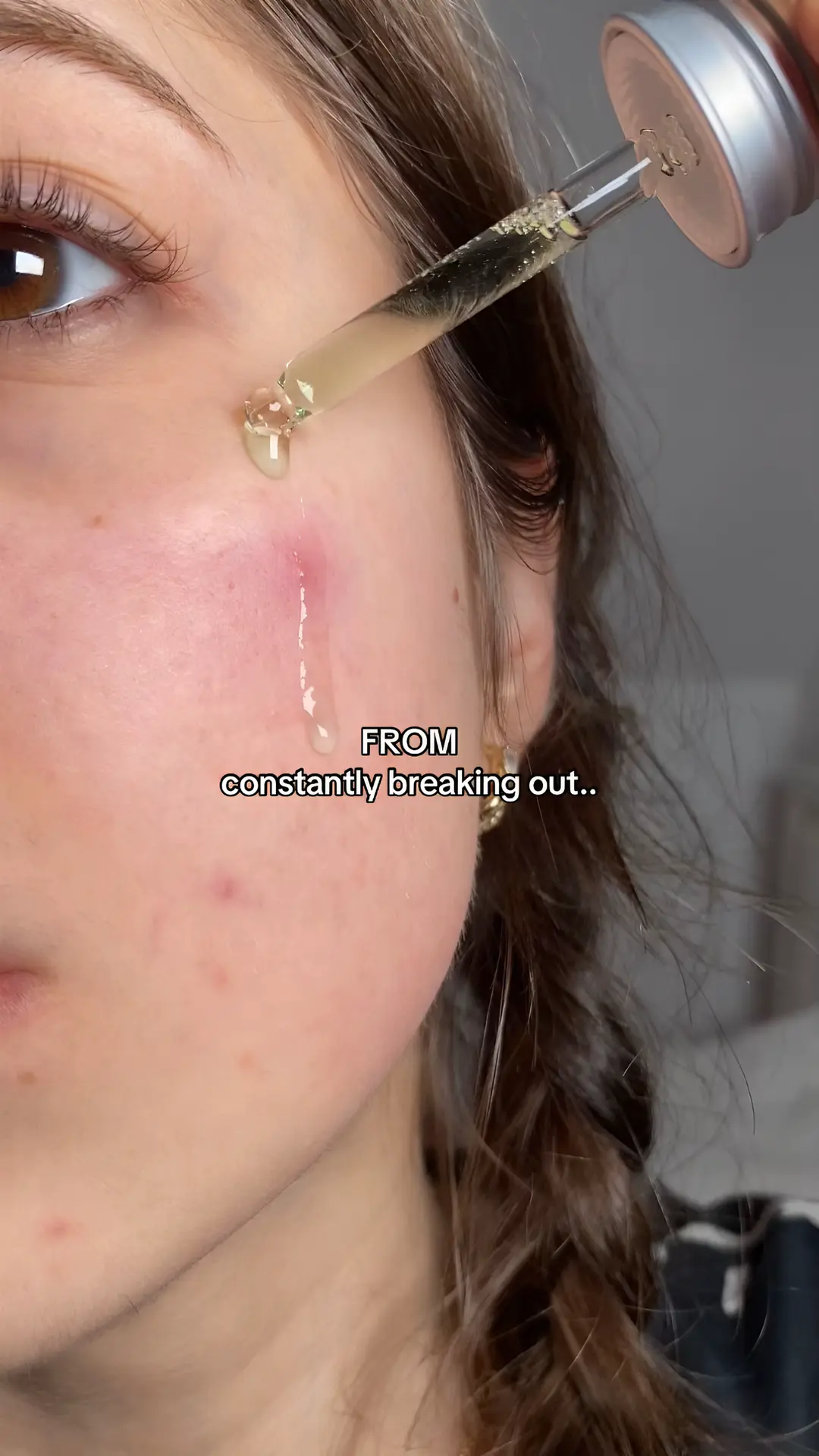 Clear skin tips I wish I knew sooner #clearskin #skincaretips #acneprone #acnesa