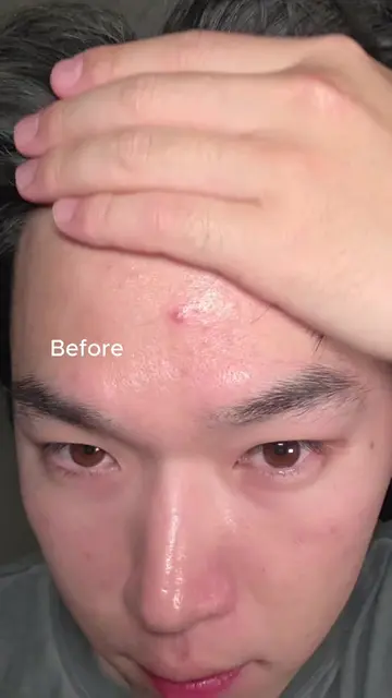 A newly discovered acne serum that helps prevent acne scars.  #egf #blueserum #k