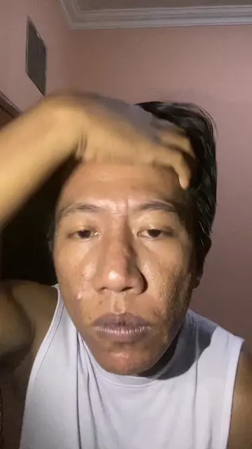 Usaha aku sembuh dari jerawat yaitu ngelakuin ini :  1. puasa gula + tepung + ma