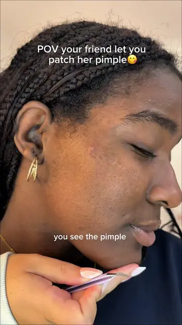 No bc the way I FORCED her to sleep over so I could patch this pimple😝  should 