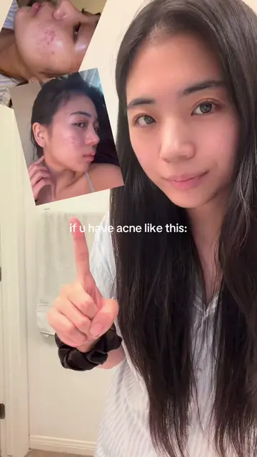 (morning+nighttime)full skincare routine for acne treatment!  #acne #acnetreatme